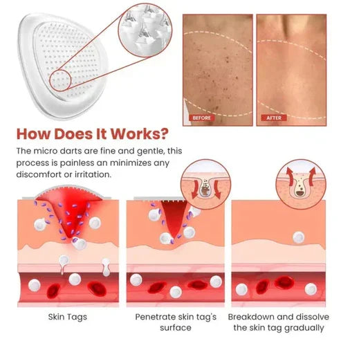 Skin Tag Remover Patch