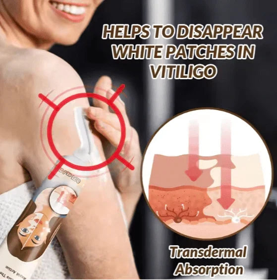 Sumifun Vitiligo Treatment Cream